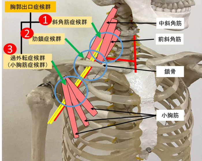 胸郭出口症候群|千葉県市原市の五井内房整骨院